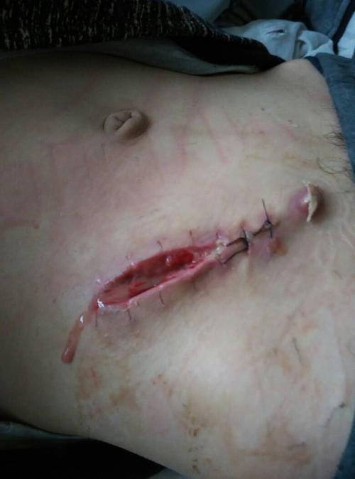 本人在淮南市第一人民医院做了个阑尾炎手术,都一个星期了,伤口发炎溃