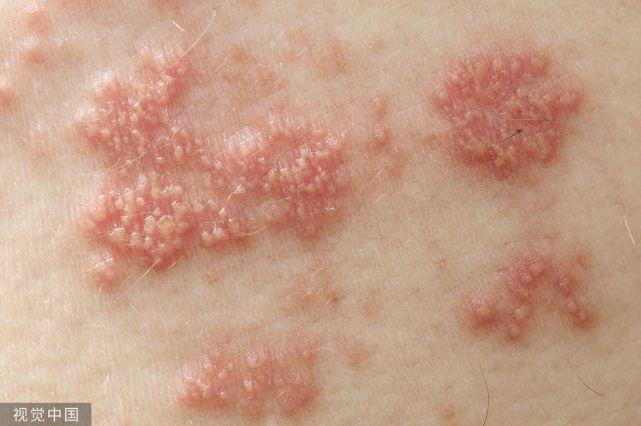 是一种累及神经和皮肤的常见疱疹性皮肤病