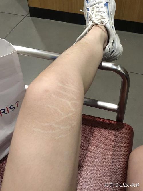 生长纹/肥胖纹(白色的有点波浪线的)有淡化成功的么?