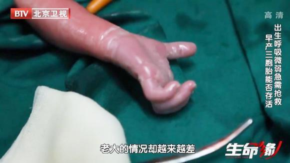 生命缘:三胞胎接连出生,但老大的情况却越来越差!