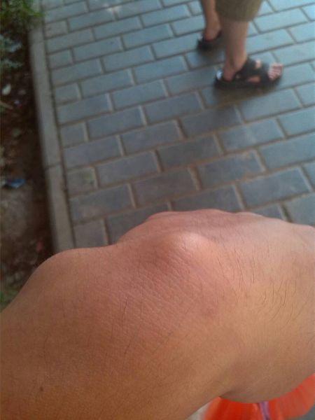 问:两个月前手腕长了个疙没在意现在变大了,这是咋了