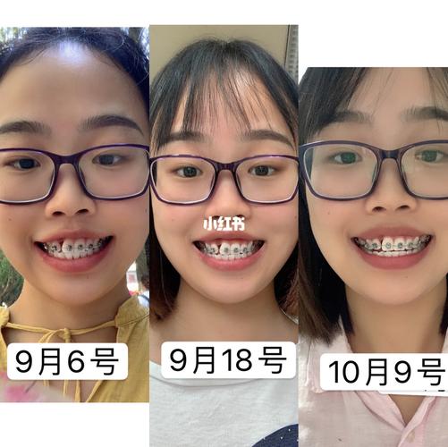 带牙套一个月,变化还是很明显的_牙套_美妆_医美整形