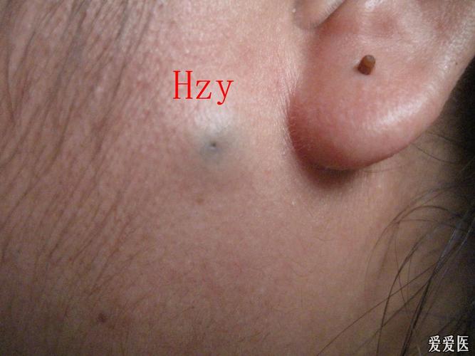 看图诊病----------皮脂腺囊肿(粉瘤)