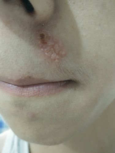 鼻子下面出了个疙瘩,应该是上火出的火疙瘩吧,挤得里面有脓,用蒸脸器