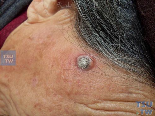 良性肿瘤:角化棘皮瘤(keratoacanthoma)症状表现