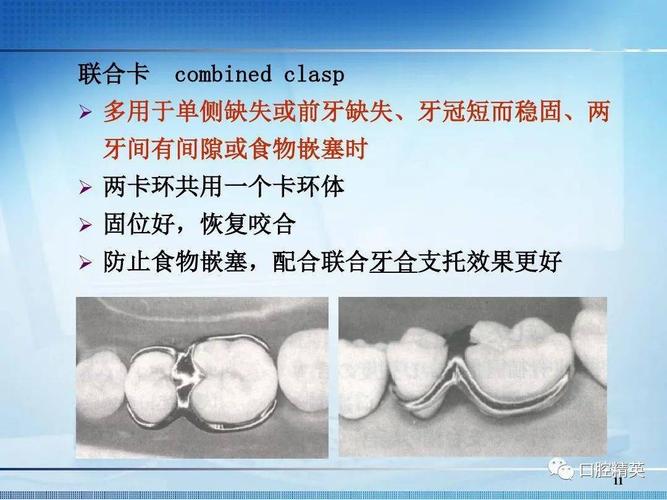 可摘局部义齿卡环的种类