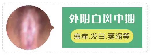 外阴白斑早,中,晚期,怎样才能针对性的治疗!