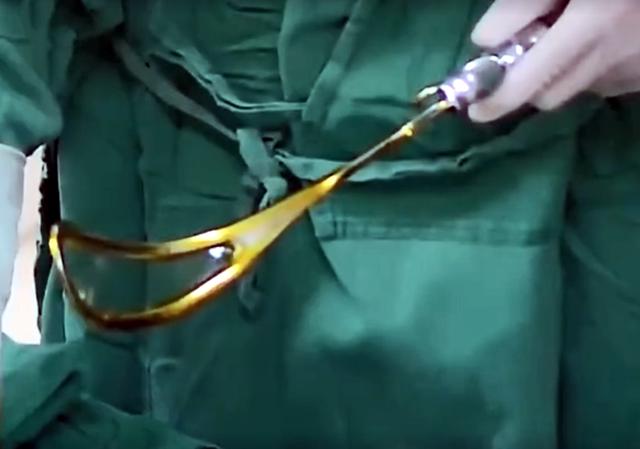 "医生,求你别用产钳",妈妈产床上毅然转顺为剖,决定让