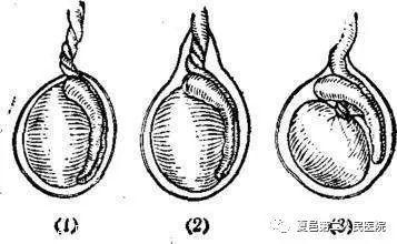 急症早知道睾丸突发红肿疼痛必须尽快就诊谨防睾丸扭转坏死