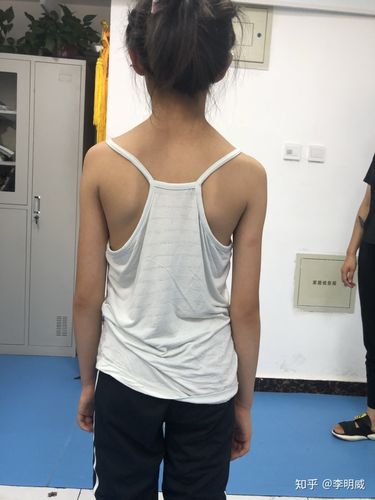 家长就站在孩子身后,观察是否有高低肩,骨盆是否有不正的感觉(具体