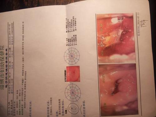 问:宫颈高级上皮内瘤变并累及腺体