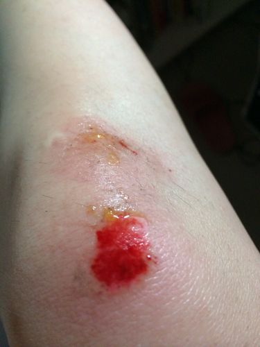 跌伤膝盖怎么处理?红药水还是紫药水还是双氧水?急!