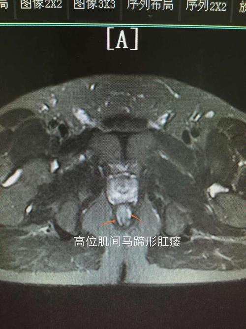手术案例:高位肌间马蹄形肛瘘行tropis 肛管后间隙切开一例