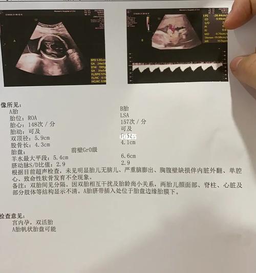 双胞胎,一个帆状胎盘_双胞胎_胎盘_b超_母婴_孕产经验