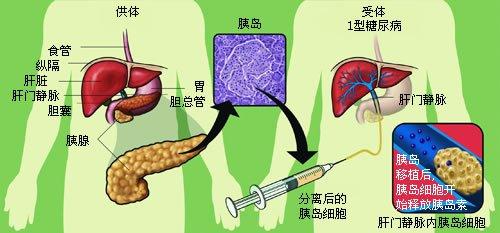 胰岛移植可恢复葡萄糖反调节