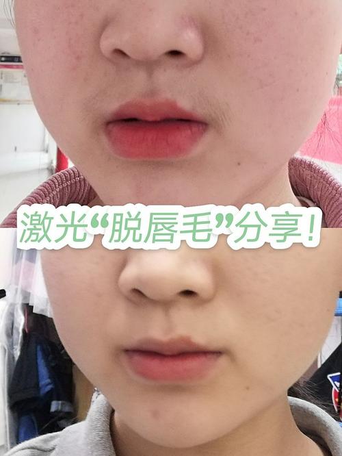 我是在新氧上买的1元激光脱唇毛或者腋毛单次体验.