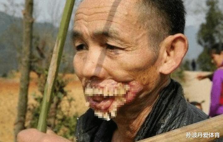 男子嘴巴畸形, 几十年过着"非人"的生活, 男子: 小时候被狼舔过