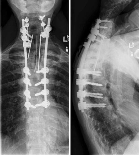 脊柱初次术后13年随访站立位胸椎x线