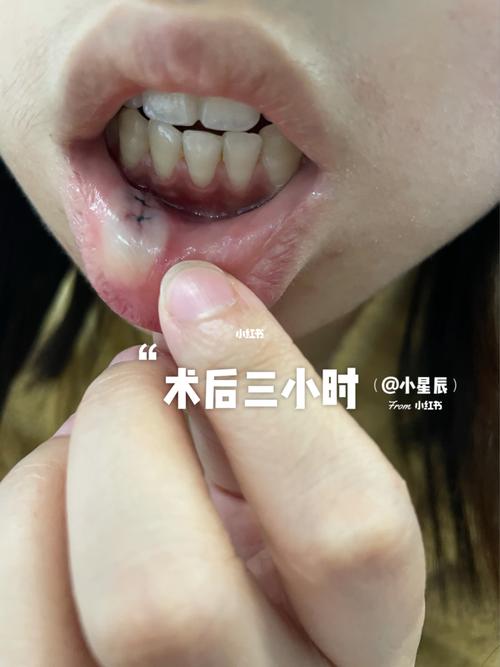 嘴唇内壁长泡,不痛不痒,是粘液腺囊肿._牙医_口腔溃疡