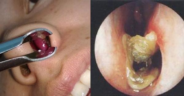 用这治鼻炎真是太厉害!根本花不到几块钱,连中医师都