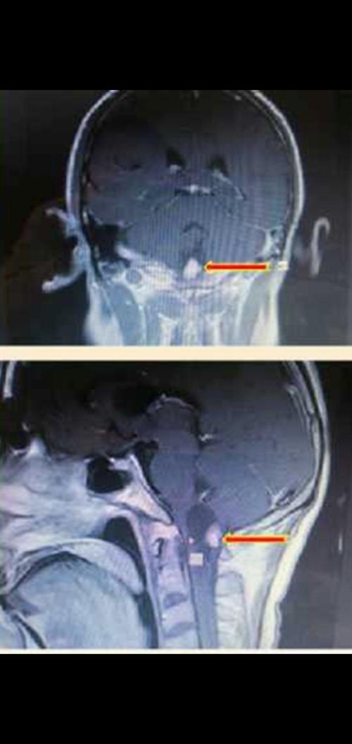 术前增强mri可见较大病变位于延髓颈髓交界处,部分呈囊性,脑干明显