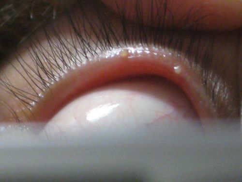 眼皮内长了两个黄色透明小泡