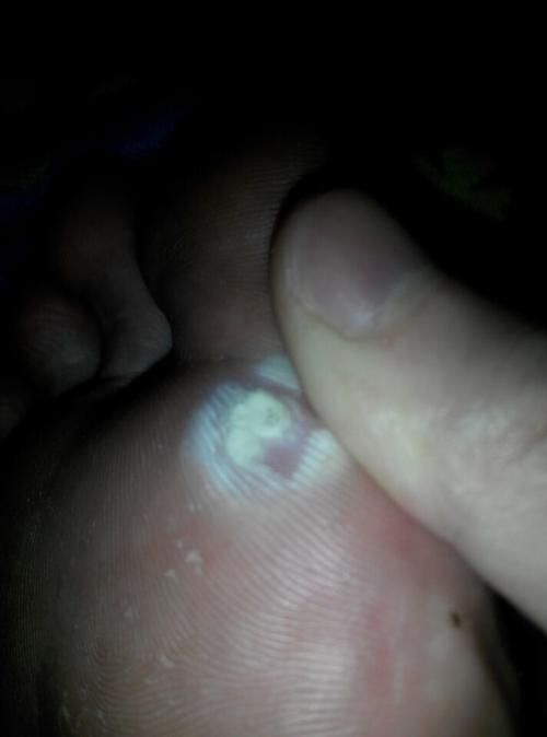 请问这个是鸡眼吗?