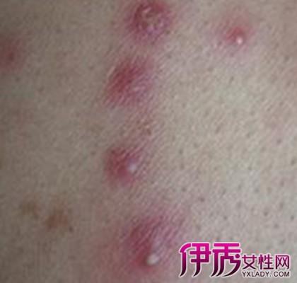 带你认识女性霉菌感染症状图 识别危机好好保护自己