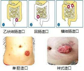【荐读】肠造口患者居家护理注意事项