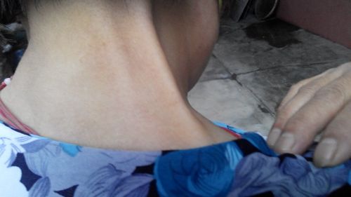 家里老人这两天脖颈部位凸起一根筋,差不多有一周左右