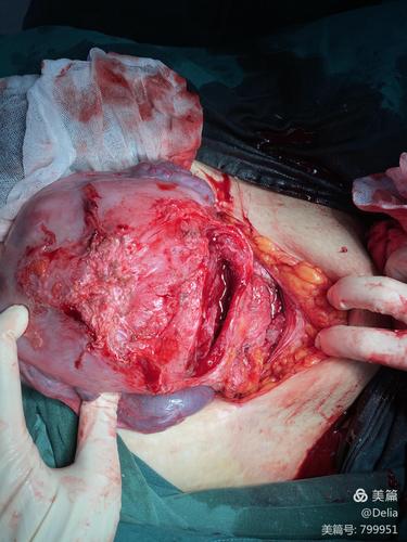 三次剖宫产史妊娠腹部切口疤痕呈t型,再次手术切口