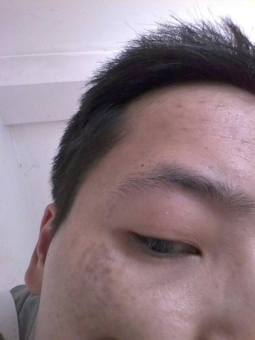 我是男的,今年24岁,眼角长斑,有好几年了,以前没注意