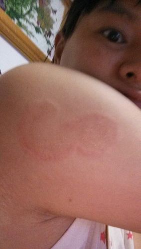 这是圆癣吗?应该擦什么药膏呢?