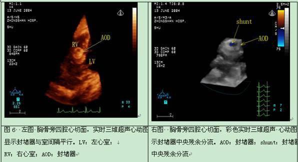 造影超声心动图