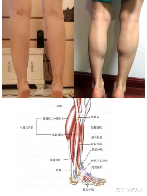 神经阻断瘦小腿:小腿肌肉过于发达,腿部线条视觉上会粗犷