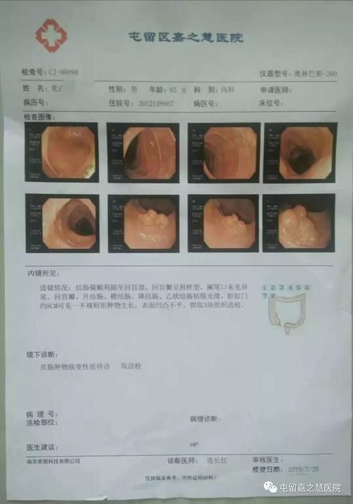 屯留区首例esd内镜黏膜下剥离术消化道早癌的首选治疗