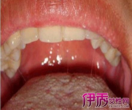 【图】艾滋病的皮肤特征有哪些 告诉你2大治疗方法