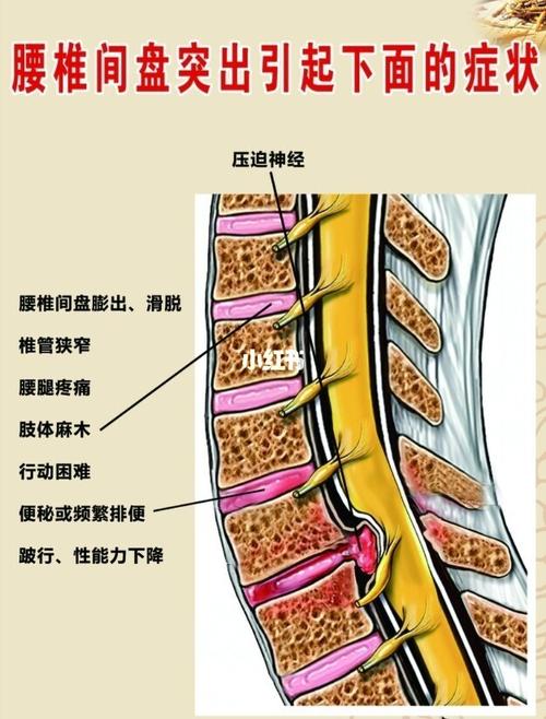 腰间盘突出_中药_腰椎_中医_炎症_医疗健康_医疗健康其他