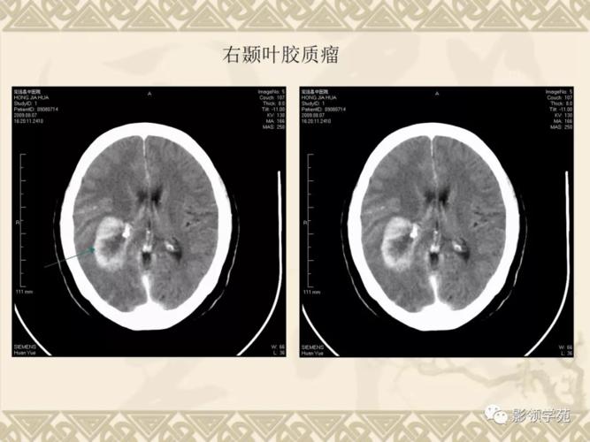 其强化原因为肿瘤新生血管及内皮细胞增生区,可反映血脑屏障破坏的