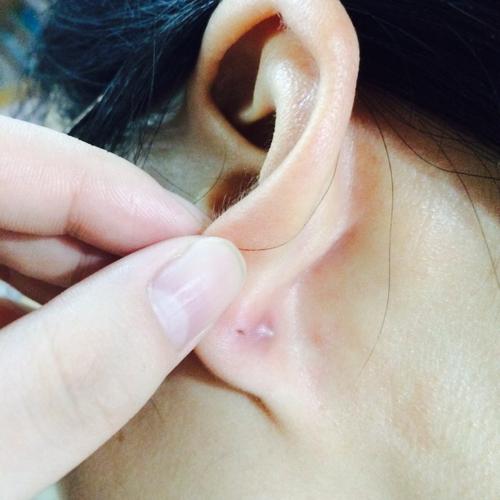我的耳洞旁边长了个包 然后就没戴 过了三四天以后有点堵塞不进去.