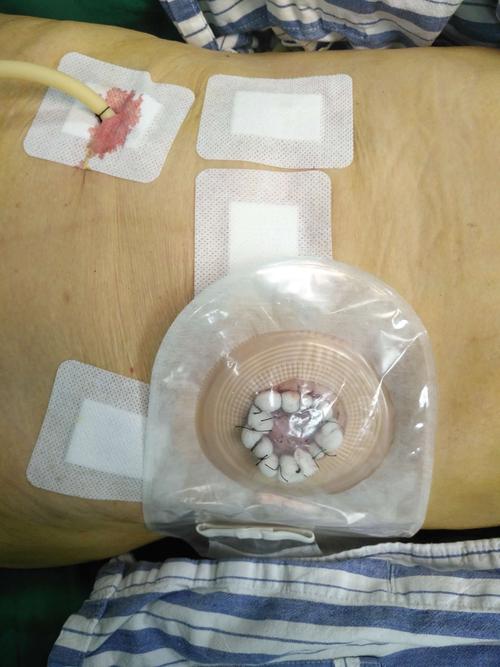 ——一例腔镜直肠穿孔乙状结肠及直肠中上段切除 降结肠造瘘术.