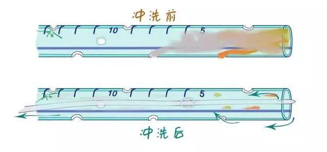 画说引流管:教你轻松搞定腹腔冲洗(第二节)