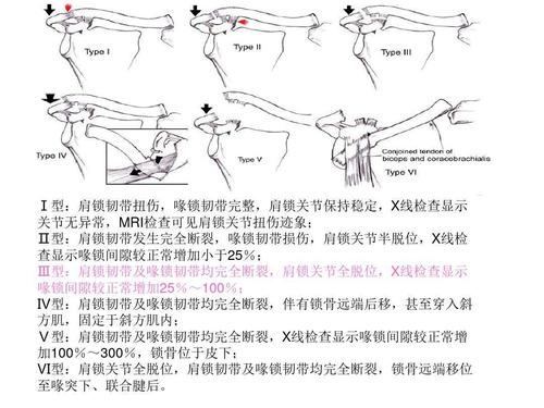 陈旧性肩锁关节脱位一期喙锁韧带,肩锁韧带重建,double endobutton