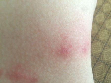 晚上习惯裸睡,早晨起来发现有些红疹,胸前和背部,请问是虫咬的吗.