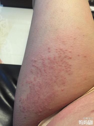 有七月份的宝妈长湿疹的么?