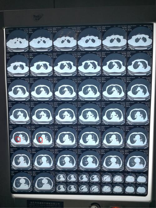 食管癌术后十年,2018年五月份发现肺部转移,七月份再次查ct见肿瘤明显