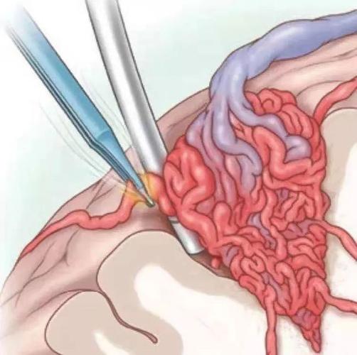 颅内大出血是脑动静脉畸形术中最严重的并发症,一旦发生会有致命危险