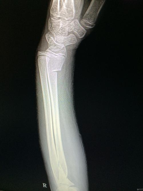 小儿桡骨远端青枝骨折