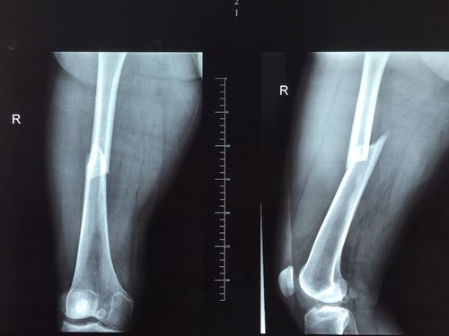 岳阳市长炼医院外一科一例股骨骨折病例分享