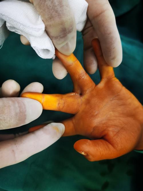 改变患儿一生-----指蹼成型术